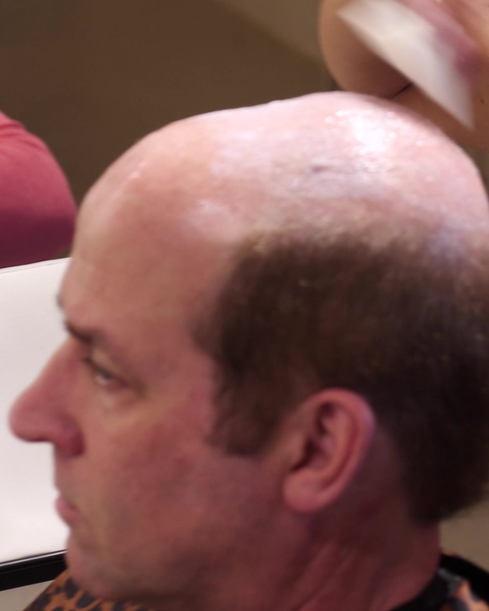 A Studio Beige client in profile before his hair system, with a bald crown